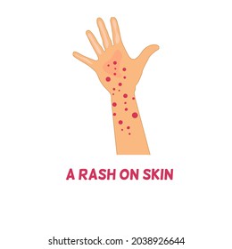 A rash on hand concept, hand and arm with red dots, red spot on hands 