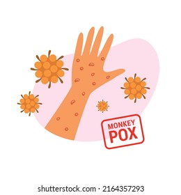Erupción en la mano, síntomas de varicela. Brote epidémico mundial. Concienciación sobre la propagación de enfermedades. Ilustración vectorial en estilo plano.