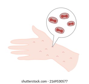 La erupción en la mano humana es un síntoma patológico de la viruela o de la viruela que se produce por la infección por el virus Variola (Poxvirus).