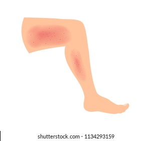 Rash On Leg Skin Vector