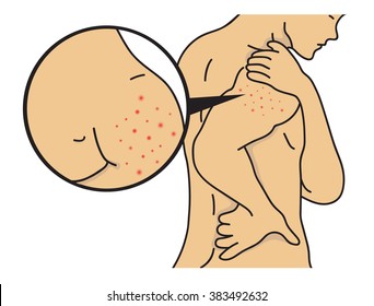 rash on shoulder