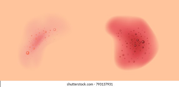 Rash On Skin Vector