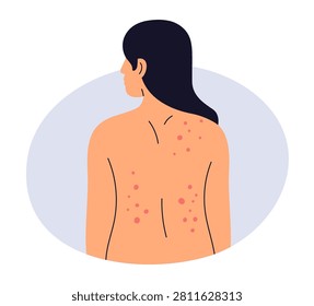 Rash, red marks and pimples on back. Allergic sensitive skin reaction, acne, insect bites. Dermatology problem. Allergy, itch, dermatitis on body. Flat vector illustration isolated on white background