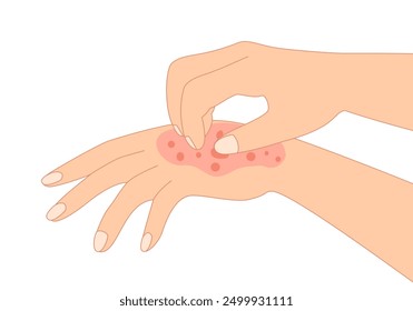 Rash skin on hand. Scratching arm in red spot, dermatitis allergy symptom skin disease.