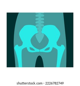Ray of human hip joint vector illustration. Bones of skeleton, roentgen, radiography isolated on white background. Anatomy, medicine, health concept