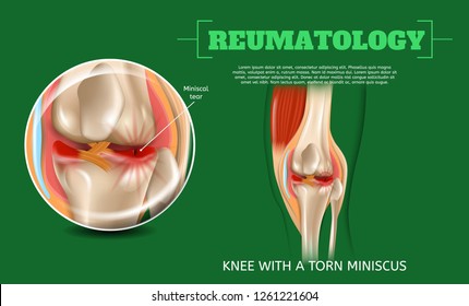 Realistic 3d Illustration Knee with Torn Miniscus. Vector Image Reumatology Anatomy Human Knee. Medical Visualization Knee Injury, Meniscus Tear. Sprain Painful Contusion Leg Joint. Operational Case