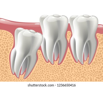 realistic 3D teeth, and wisdom tooth problems