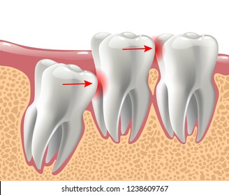 realistic 3D teeth, and wisdom tooth problems