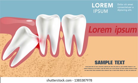 realistic 3D teeth, and wisdom tooth problems 