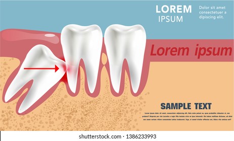 Realistic 3D teeth, and wisdom tooth problems 