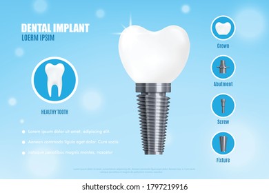 Realistic 3d vector illustration dental implant structure with its parts - crown, abutment, screw. Medical poster or banner with dental implant advertisement.