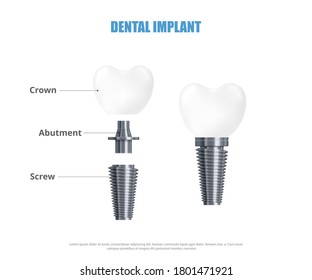 Realistic 3d vector illustration dental implant structure. Medical poster or banner with dental implant parts - crown, abutment, screw.