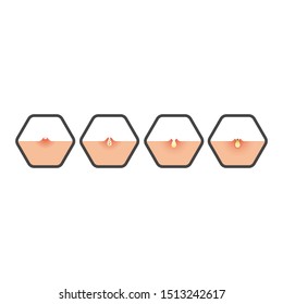 Ilustración vectorial de Acne y Pimples realistas.