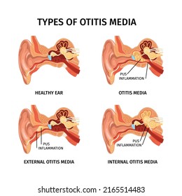 Realistic anatomy ear otitis set of four isolated anatomic diagrams with text captions and internal organs vector illustration