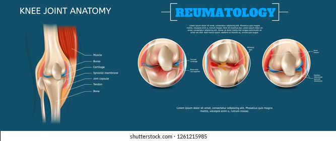 Realistic Banner Illustration Knee Joint Anatomy. 3d Vector Reumatology Image Constituent Elements Structure Human Knee Joint Muscle, Bursa, Cartilage, Synovial Membrane, Jont Capsule, Tendon, Bone.