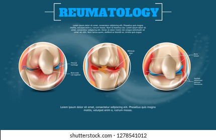 Realistic Banner Illustration Reumatology Vector. 3d Image Medical Poster with Visualization Anatomy Human Knee from Different Sides. Scientific Manual for Study Structure Knee Joint