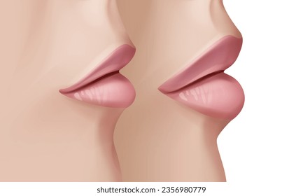 Realistic before and after vector illustration of woman having facial beauty botox injection. Lips closeup.