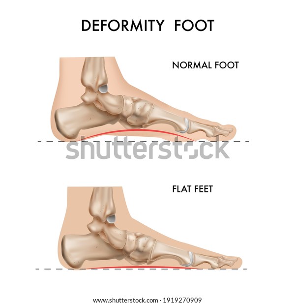Realistic bones anatomy foot arch\
deformation composition with profile views of footstep with\
editable text captions vector\
illustration
