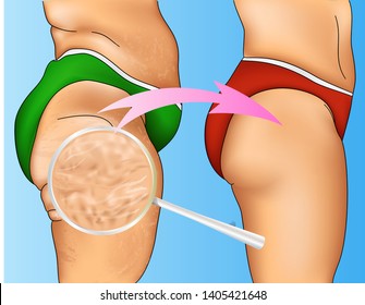 Realistic colorful illustration of woman cellulite with arrow designation and magnifying glass