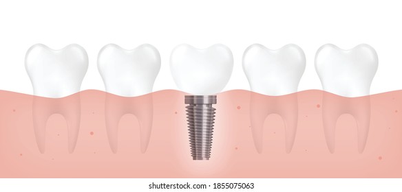 Realistic dental implant among healthy teeth row on gums. Medical banner of inserted metal screw inside mouth gum next to other tooth roots, vector illustration