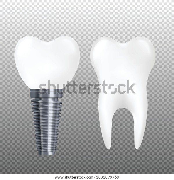 Realistic dental implant and\
healthy tooth isolated on transparent background. Ceramic crown on\
metal screw and white molar with roots, vector\
illustration.