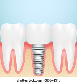 Realistic Dental Implant. Installation Of Dental Implant With All Parts Crown, Abutment, Screw Isolated On A Background. Vector Illustration. Stomatology. Creative Medical Concept