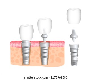 Realistic dental implant structure with all parts: crown, abutment, screw. Dentistry. Implantation of human teeth. Vector illustration