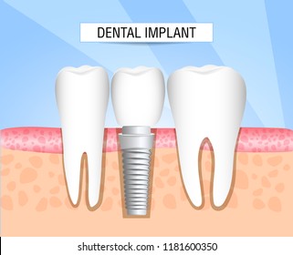 Realistic dental implant structure with all parts: crown, abutment, screw. Healthy teeth and dental implant. Dentistry. Implantation of human teeth. Vector illustration
