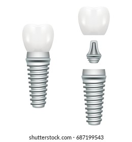 Realistic Dental Implant Structure With All Parts Crown, Abutment, Screw Isolated On A White Background. Vector Illustration. Stomatology. Creative Medical Concept