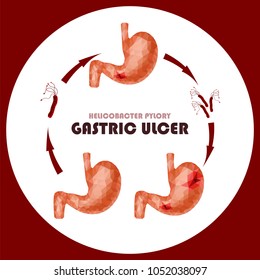 Realistic faceted low poly human stomach and duodenum concept. Healthy stomach, ulcer diseases, helicobacter pylori bacteria attack, pills cure the inflammation. Gastric ulcer medical banner. Vector