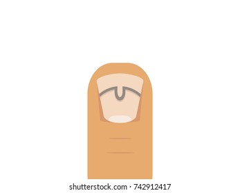 Realistic flat design vector illustration of common medical issue treatment of ingrown nail  using brace/buckle
