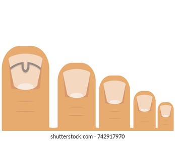 Realistic flat design vector illustration of common medical issue treatment of ingrown nail  on foot using brace/buckle