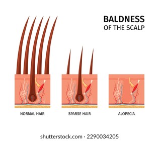 Realistic hair structure composition with text captions and isolated views of normal sparse hair and alopecia vector illustration