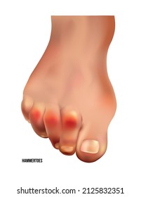 Realistic Hammer Toes Of Human Leg With Red Pain Points Frontal View.