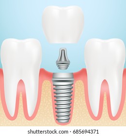 Realistic Healthy Teeth And Dental Implant. Installation Of Dental Implant With All Parts Crown, Abutment, Screw Isolated On A Background. Vector Illustration. Stomatology. Creative Medical Concept