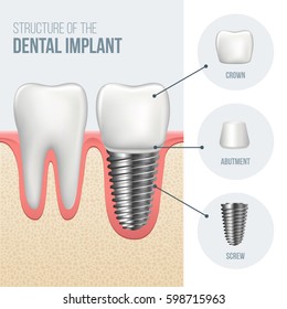 Realistic healthy tooth and dental implant structure with all parts: crown, abutment, screw. Vector illustration