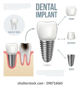 歯科インプラント構造医療画像教育インフォグラフィックポスター モル置き換え用ヘルシーツールモデルベクターイラスト のベクター画像素材 ロイヤリティフリー Shutterstock