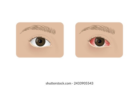 Realistic human healthy eye and with conjunctivitis vector illustration design. Red dry eye syndrome, anatomy, health and allergies.