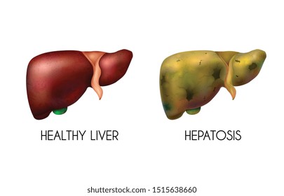 Realistic human internal organs liver healthy normal unhealthy fatty composition with two different colors when the disease is present vector illustration