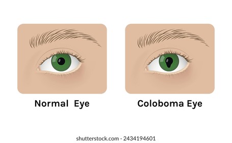 Realistic human normal eyes and with colomba vector illustration design. Human malady, anatomy, health.
