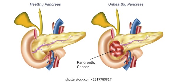 Realistic human pancreas diseases vector illustration. cystic fibrosis, annular pancreas, acute pancreatitis, enlarged pancreas, pancreas inflammation, anatomic abnormality. endocrine, exocrine. 