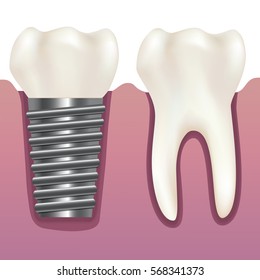 Realistic Human Tooth and Dental Implant Stomatology Health Care Concept. Vector illustration