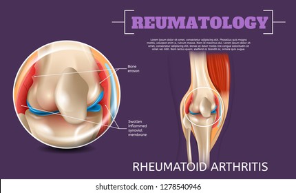Realistic Illustration Knee Rheumatoid Arthritis. 3d Vector Image Reumatology Anatomy Human Knee. Medical Visualization Long Standing Knee Injury. Poster Study Structure, Surgical Problems Leg Joint