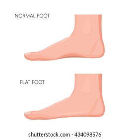 Realistic illustration of a normal foot and a flat foot.