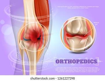 Realistic Illustration Orthopedics Medicine in 3d. Banner Vector Image Closeup Anatomy and Structure Human Knee Joint. Infographics Study Rupture and Treatment Methods Miniscal Tear