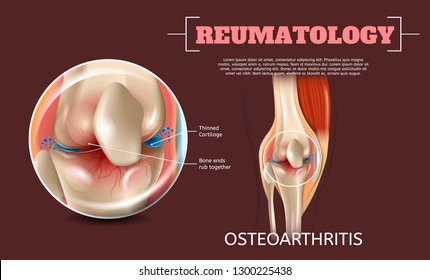 Realistic Illustration Osteoarthritis Knee Joint. 3d Banner Vector Image Reumatology Anatomy Human Knee. Thinned Cartilage, Bone ends Rub Together. Poster Study Structure, Surgical Problems Leg Joint