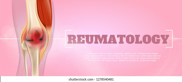 Realistic Illustration Reumatology Medicine in 3d. Banner Vector Image Closeup Anatomy and Structure Human Knee Joint. Infographics Study Place Concentration Problems and Pain as Result Disease