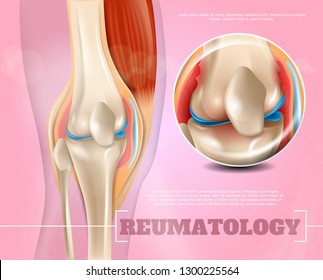Realistic Illustration Reumatology Medicine in 3d. Banner Vector Image Closeup Anatomy and Structure Human Knee Joint. Infographics Study Place Concentration Problems and Pain as Result Disease