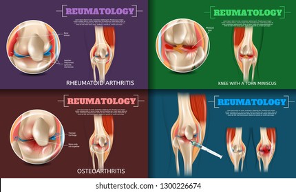 Realistic Illustration Reumatology Medicine in 3d. Banner Vector Set Image Pathological Medical Problems and Diseases of the Knee Joint. Rheumatoid Arthritis, Osteoarthritis, Knee with a Torn Miniscus