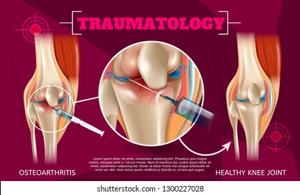 Realistic Illustration Traumatology Medicine in 3d. Vector Banner Image Anatomy Human Knee Joint Treatment Osteoarthritis Injection Drug Method Injection. Healthy Knee Joint Result Medical Treatment